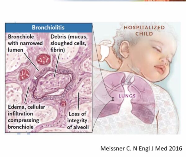 Infecciones Respiratorias Agudas (IRA) v 2.0 - Imagen 4